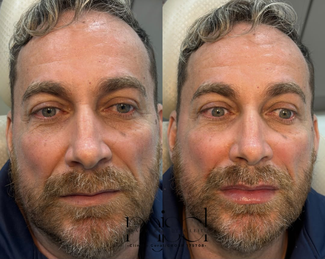 Resultado 5 — antes e depois