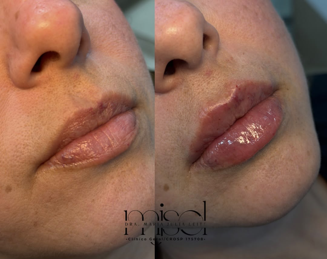 Resultado 4 — antes e depois